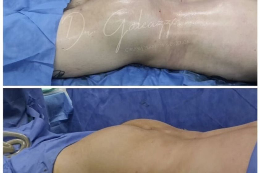 Aumento glúteos antes y después - 845210
