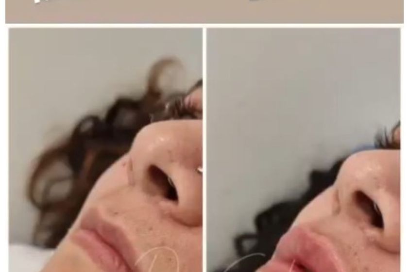Relleno de labios antes y después - 850578