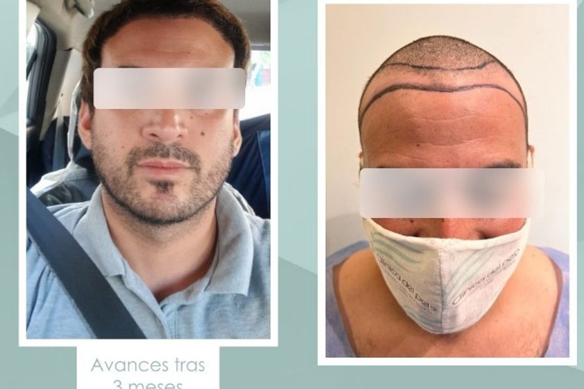 Implante capilar antes y después - 854144