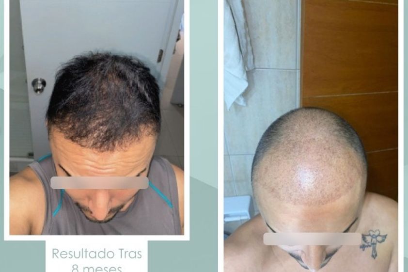 Implante capilar antes y después - 854145