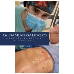 Liposucción - Dr. Damián Galeazzo y Equipo