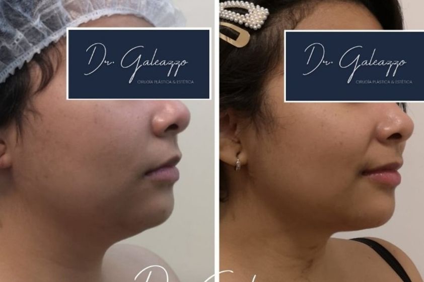 Liposucción antes y después - 856518