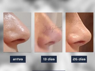 Rinoplastia antes y después - 856519