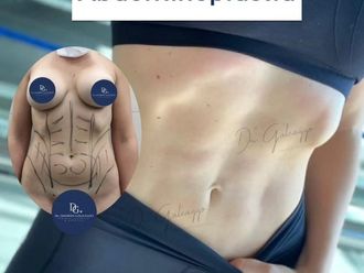 Abdominoplastía - 858392