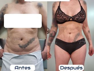 Dermolipectomía antes y después - 866952