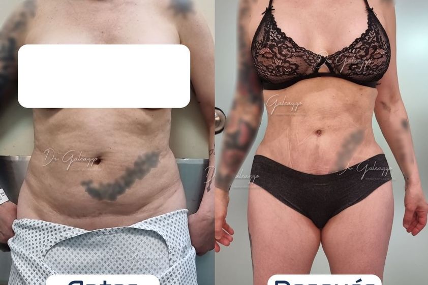 Dermolipectomía antes y después - 866952
