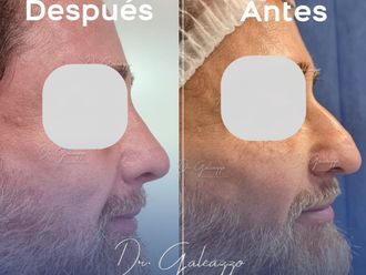 Rinoplastia antes y después - 866958