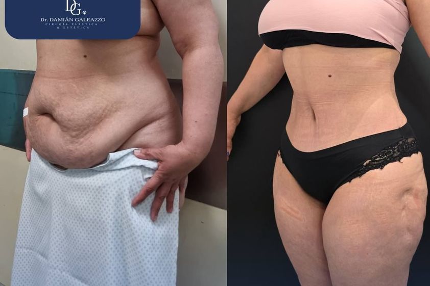 Dermolipectomía antes y después - 867966