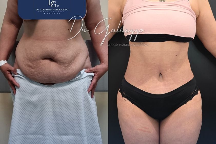 Dermolipectomía antes y después - 867967