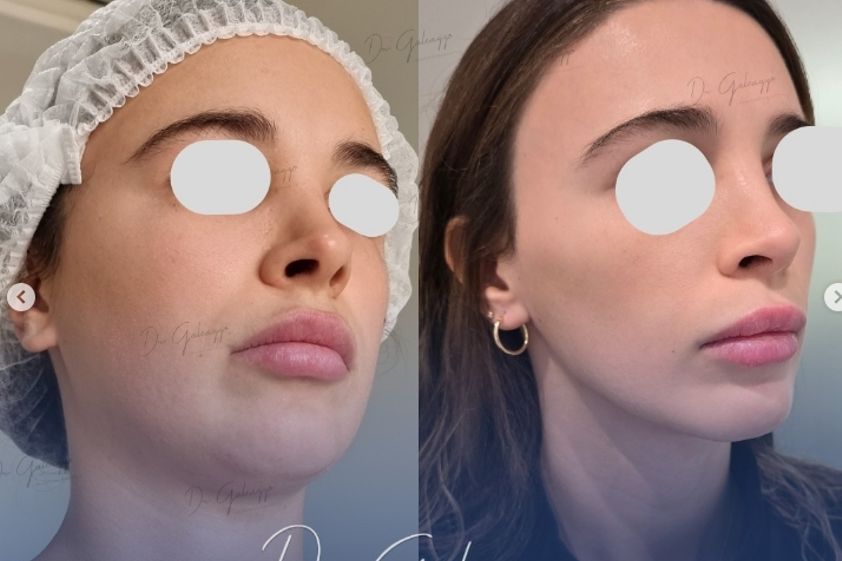 Rejuvenecimiento facial antes y después - 867968