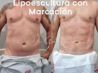 Liposucción antes y después - 868417