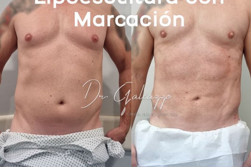 Liposucción antes y después - 868417