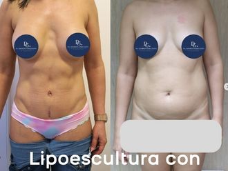 Lipoescultura - 869240