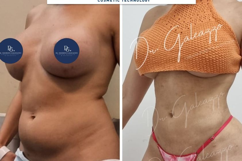 Lipoescultura antes y después - 869959