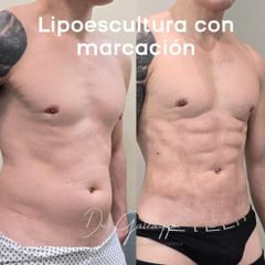 marcación abdominal en hombres - Dr. Damián Galeazzo y Equipo