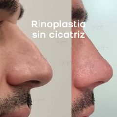 Rinoplastia - Dr. Damian Galeazzo y Equipo