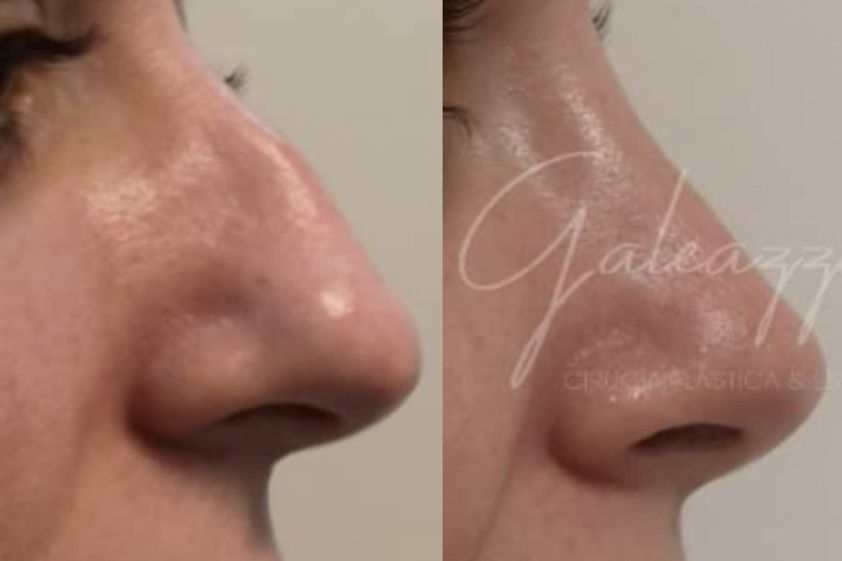 Rinoplastia antes y después - 872224