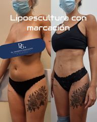 lipoescultura con marcación suave - Dr. Damián Galeazzo y Equipo