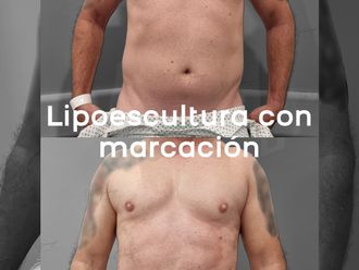 Lipoescultura antes y después - 872929