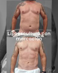 Lipoescultur con marcación abdominal - Dr. Damián Galeazzo y Equipo