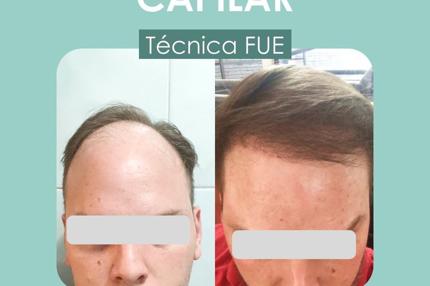 Implante capilar antes y después - 872930