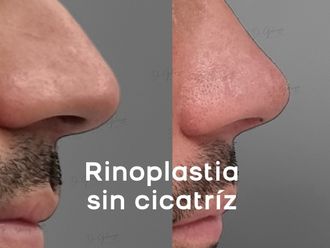 Rinoplastia antes y después - 873137