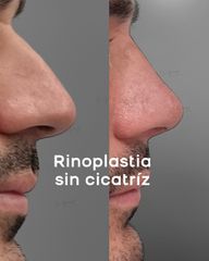 Rinoplastía SIN CICATRIZ - Dr. Damián Galeazzo y Equipo