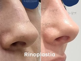 Rinoplastia antes y después - 878916