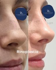 Rinoplastia cerrada - Dr. Damián Galeazzo y Equipo