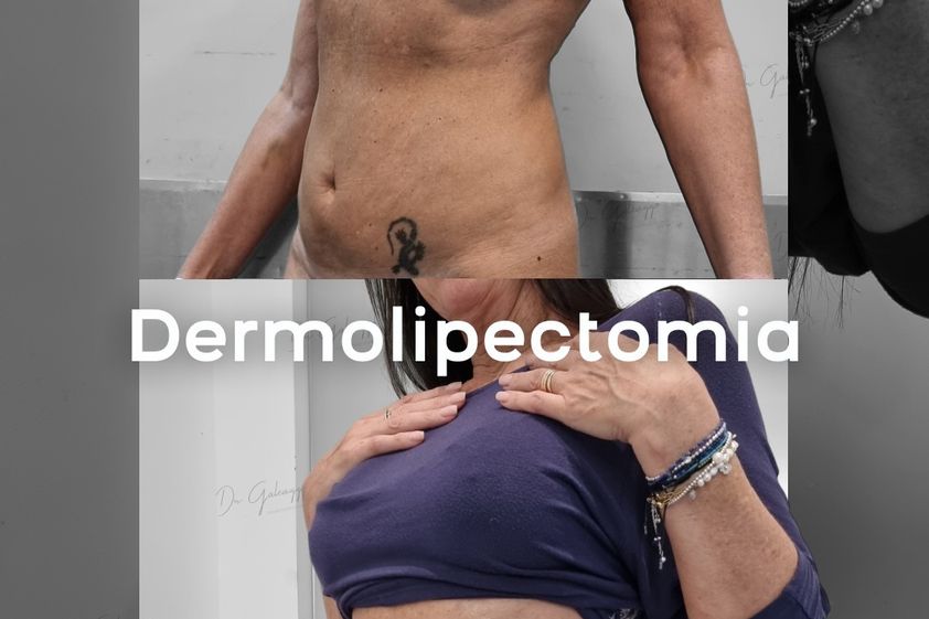 Dermolipectomía antes y después - 878917