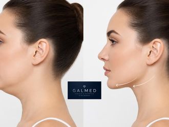 Lipopapada antes y después - 880745