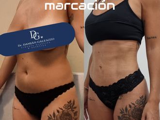Lipoescultura antes y después - 881023
