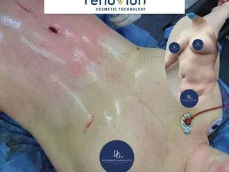Lipoescultura antes y después - 881431