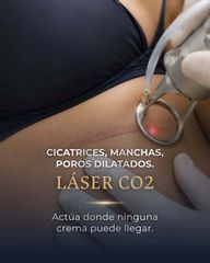 LáserCo 2 - Dr Galeazzo Cirugía Plástica | Galmed