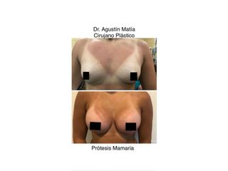 aumento mamas 1 antes y despues - dr. agustin matia