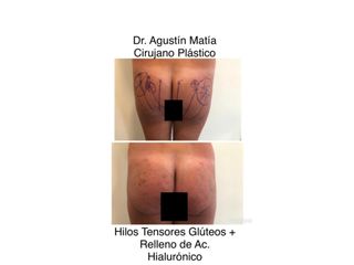 hilos tensores antes y despues - dr. agustin matia