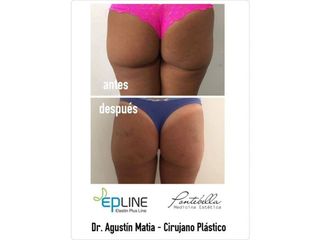 Aumento gluteos