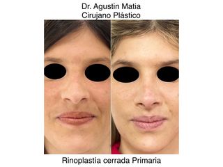 Dr. Agustín Matia - Rinoplastia