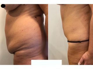 Dr. Agustín Matia - Lipoabdomindoplastia