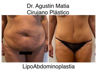 Dr. Agustín Matia - Lipoabdomindoplastia