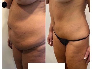 Dr. Agustín Matia - Lipoabdomindoplastia