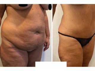 Dr. Agustín Matia - Lipoabdomindoplastia
