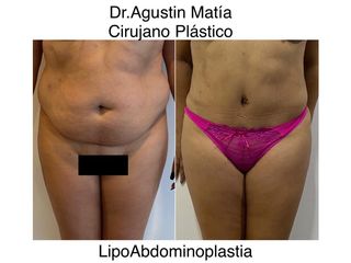 Lipoabdomindoplastia - Dr. Agustín Matia