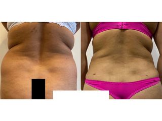 Lipoabdomindoplastia - Dr. Agustín Matia