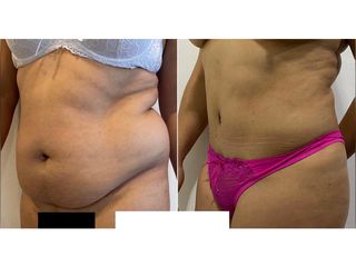 Lipoabdomindoplastia - Dr. Agustín Matia