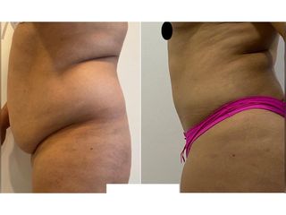 Lipoabdomindoplastia - Dr. Agustín Matia