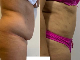 Lipoabdomindoplastia - Dr. Agustín Matia