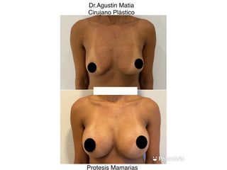 Aumento mamas - Dr. Agustín Matia