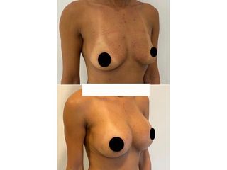 Aumento mamas - Dr. Agustín Matia
