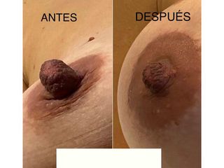 Aumento mamas - Dr. Agustín Matia